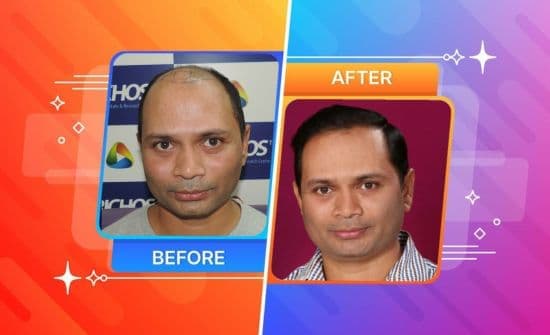 Best Hairline Hair Transplant in Hyderabad