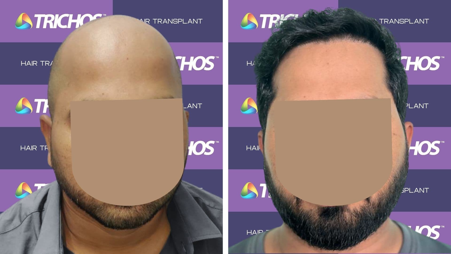 Hair Transplant Before After Result 4