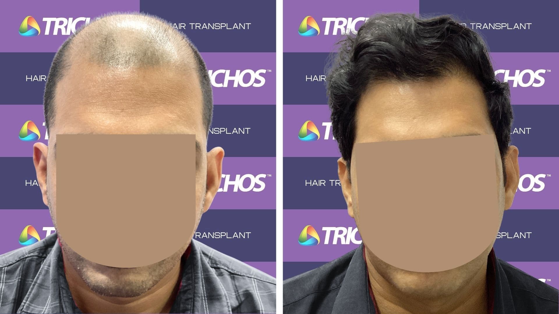 Hair Transplant Before After Result 1