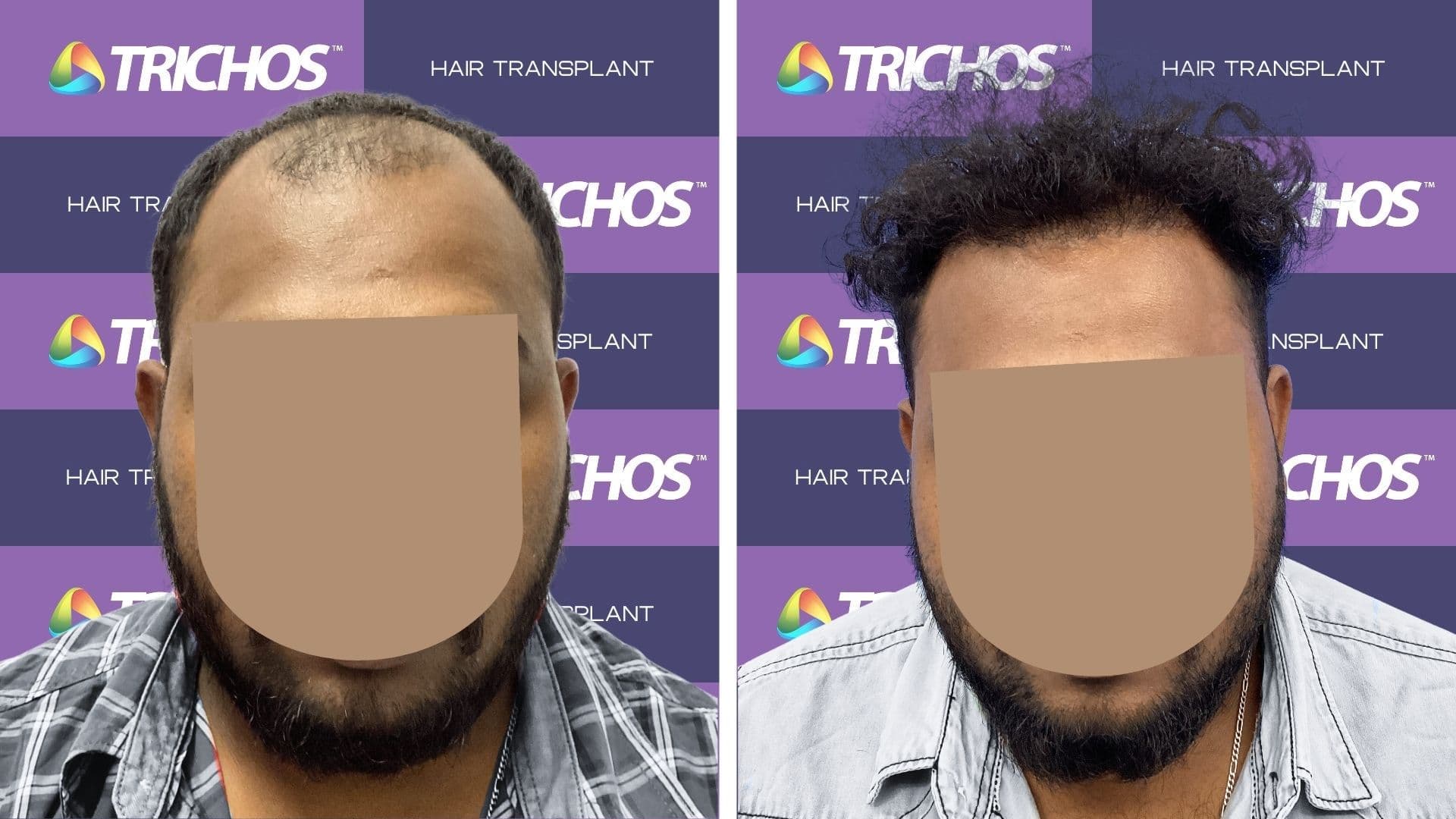Hair Transplant Before After Result 5