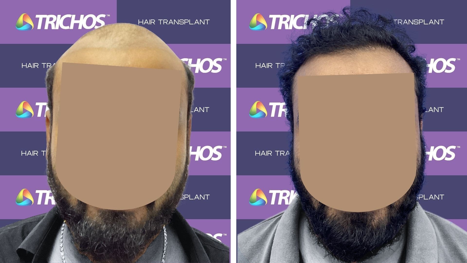 Hair Transplant Before After Result 3