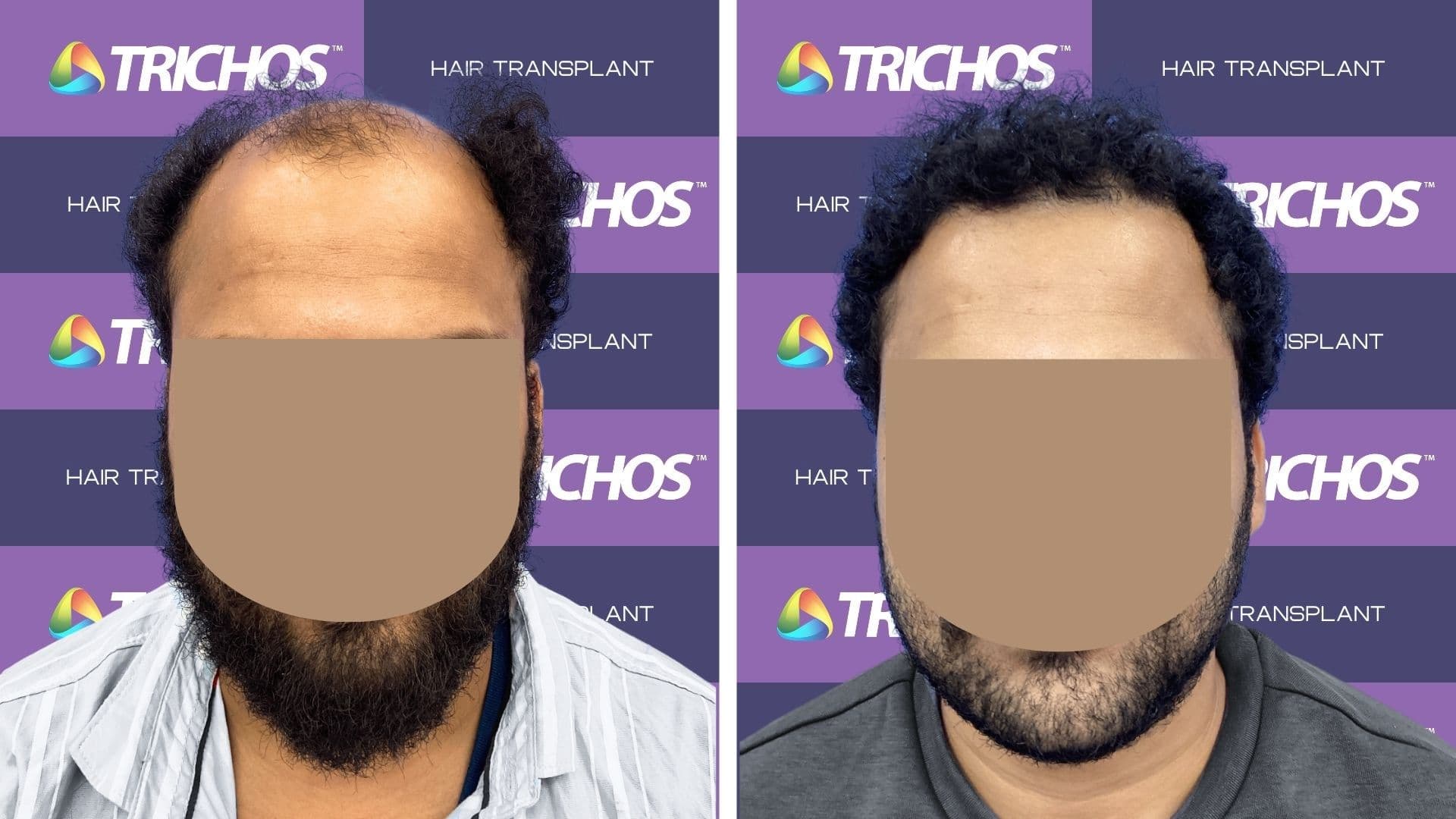 Hair Transplant Before After Result 2