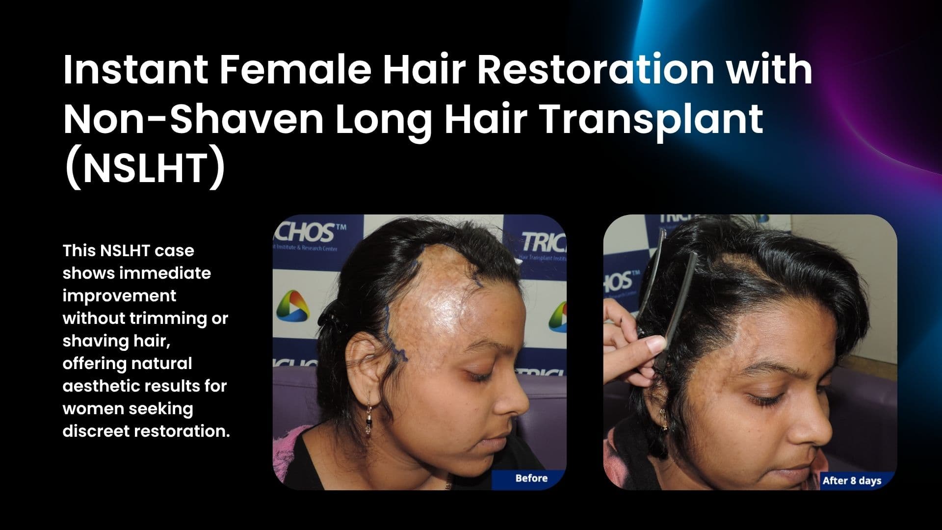 Female patient showing instant transformation after Non-Shaven Long Hair Transplant (NSLHT) at Trichos Hyderabad.