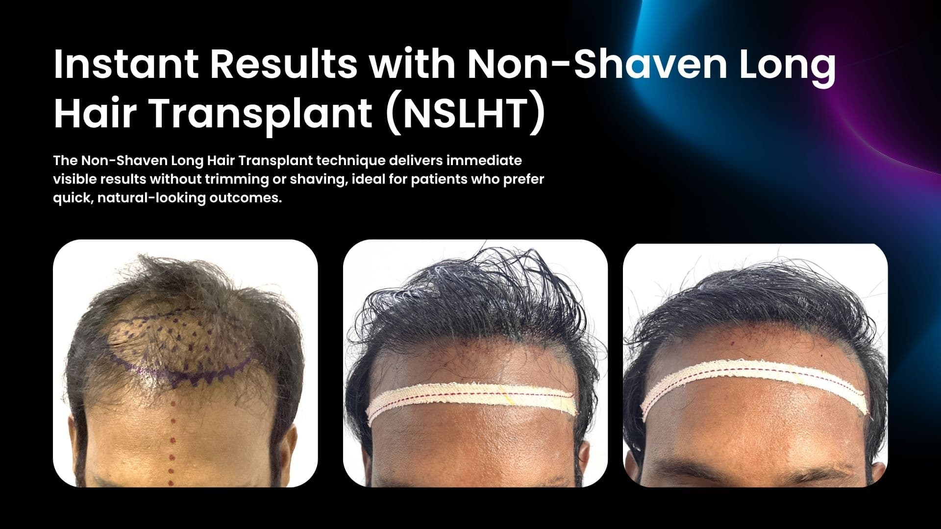 Instant visible result after Non-Shaven Long Hair Transplant (NSLHT) at Trichos Hyderabad – no trim, natural finish.