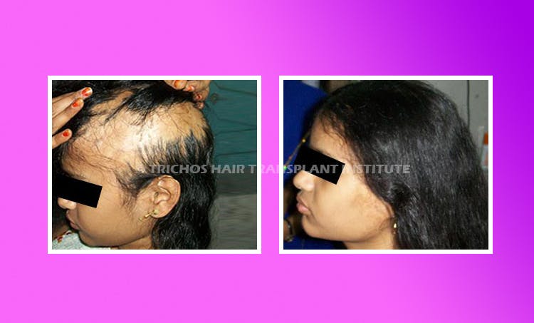 Best Burn Scar Alopecia Treatment in Hyderabad