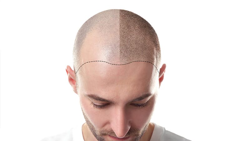 Best Baldness Treatment With Scalp Micropigmentation
