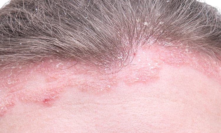Dermatitis