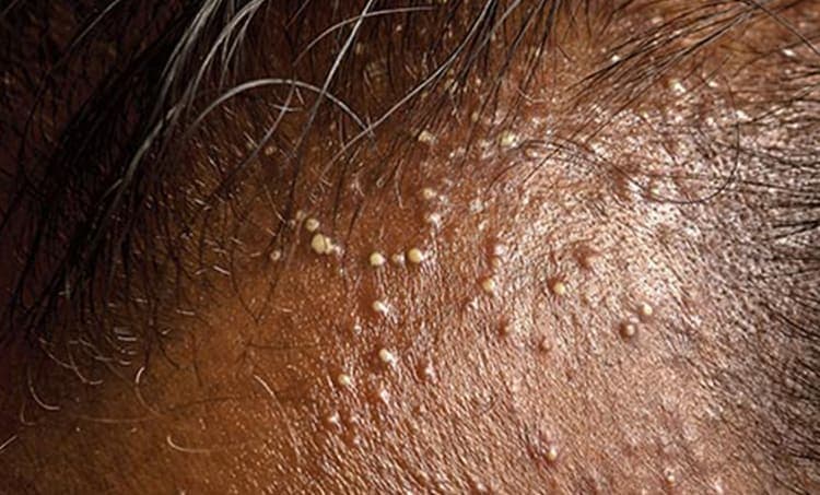 Folliculitis Decalvans