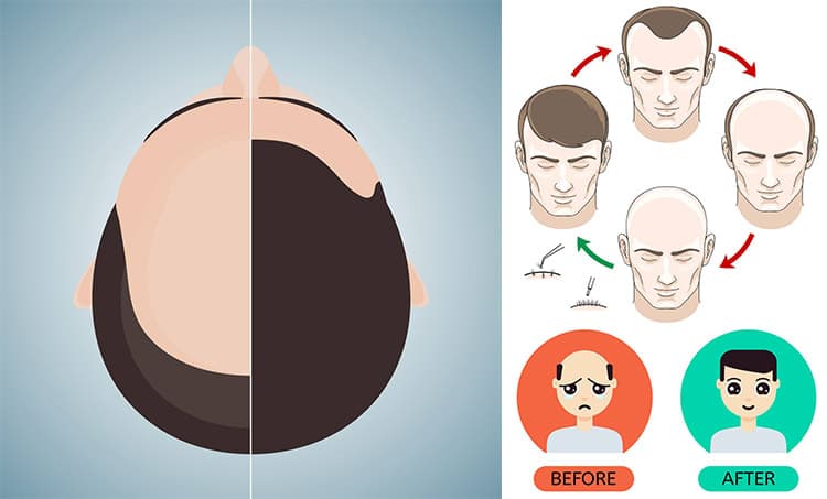 Hair Transplant in Men