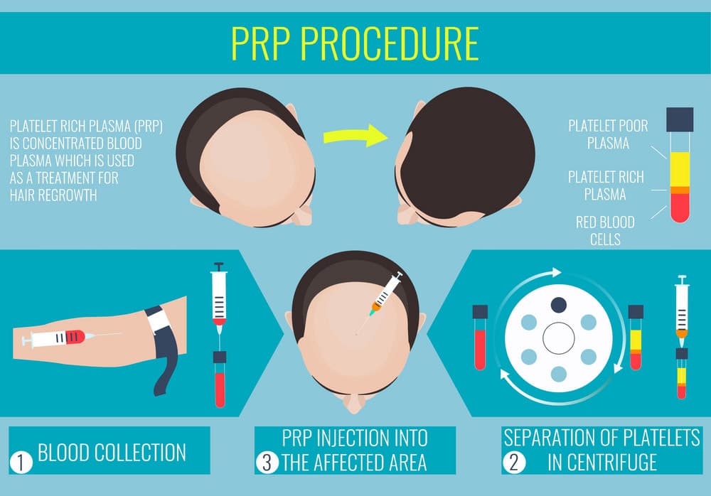 Platelet Rich Plasma (PRP)