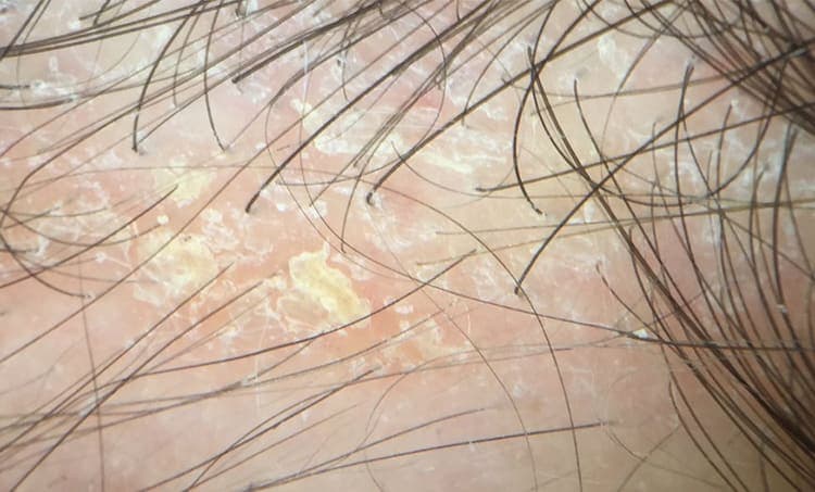 Seborrheic Dermatitis