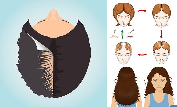 Hair Transplant in Women