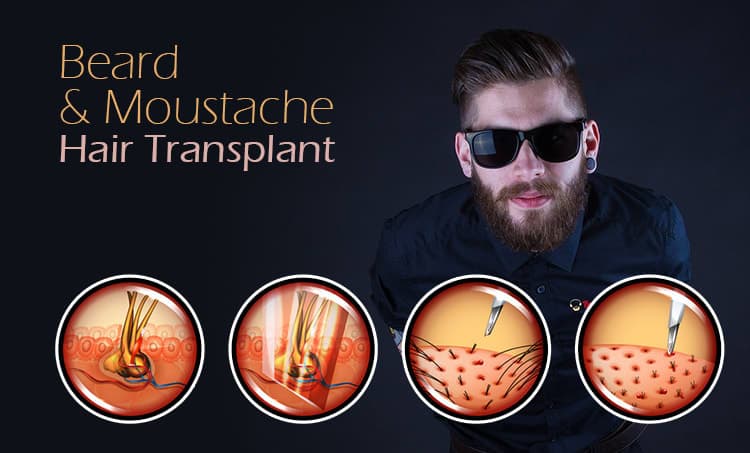 Beard & Moustache Hair Transplant