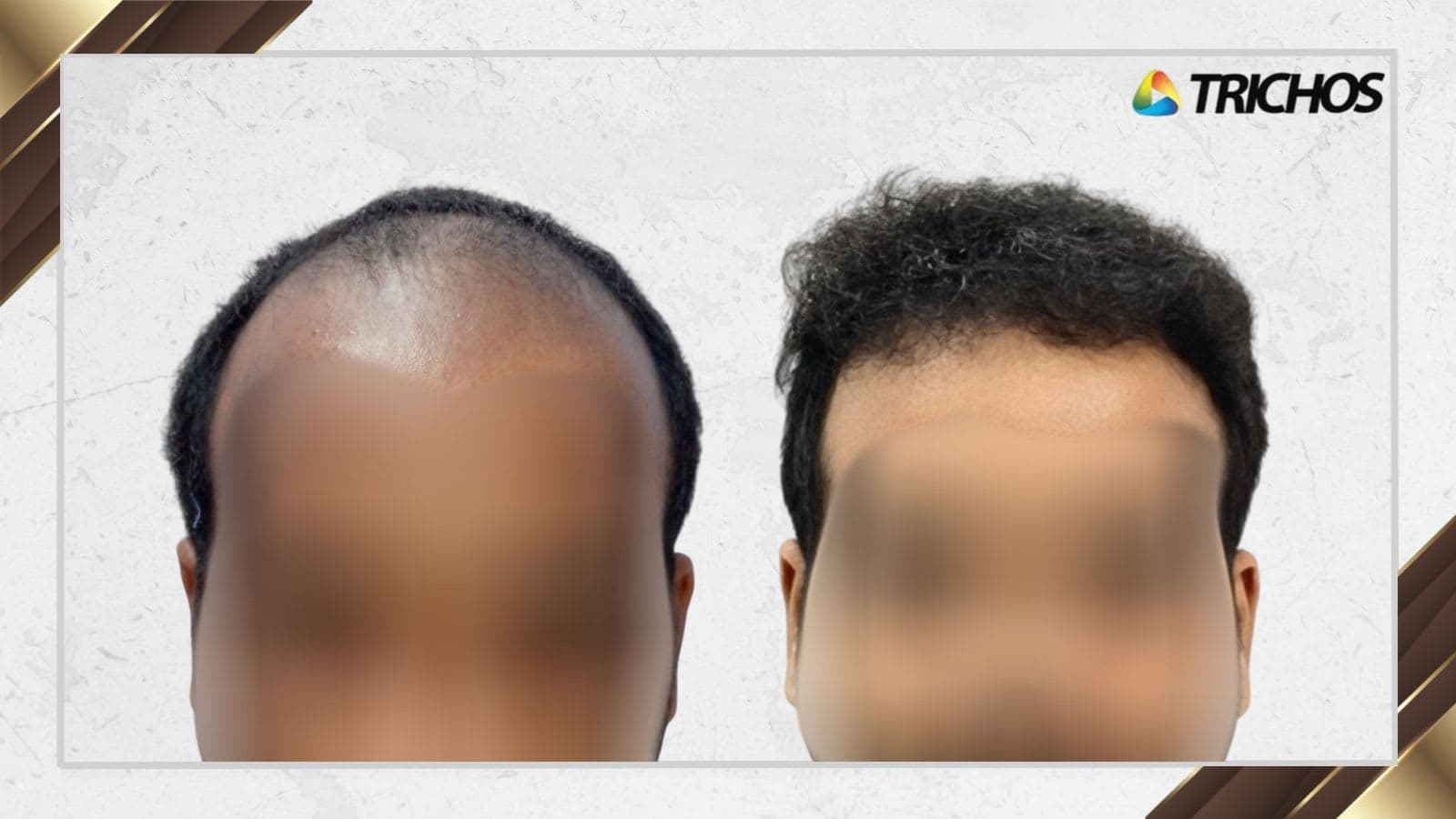 NSLHT vs FUE Hair Transplant: Key Differences Explained