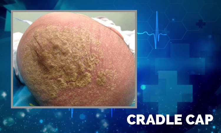CRADLE CAP