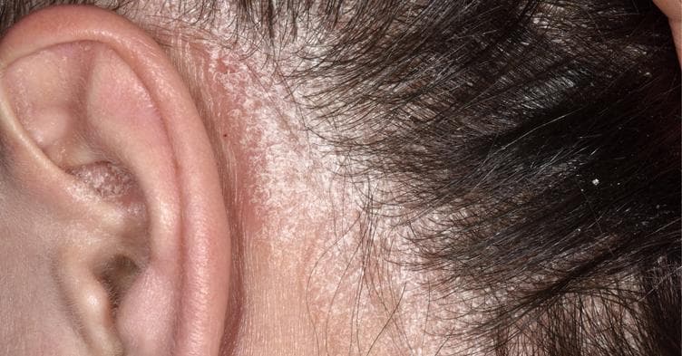 Understanding Autoimmune Disorders and Hair Loss