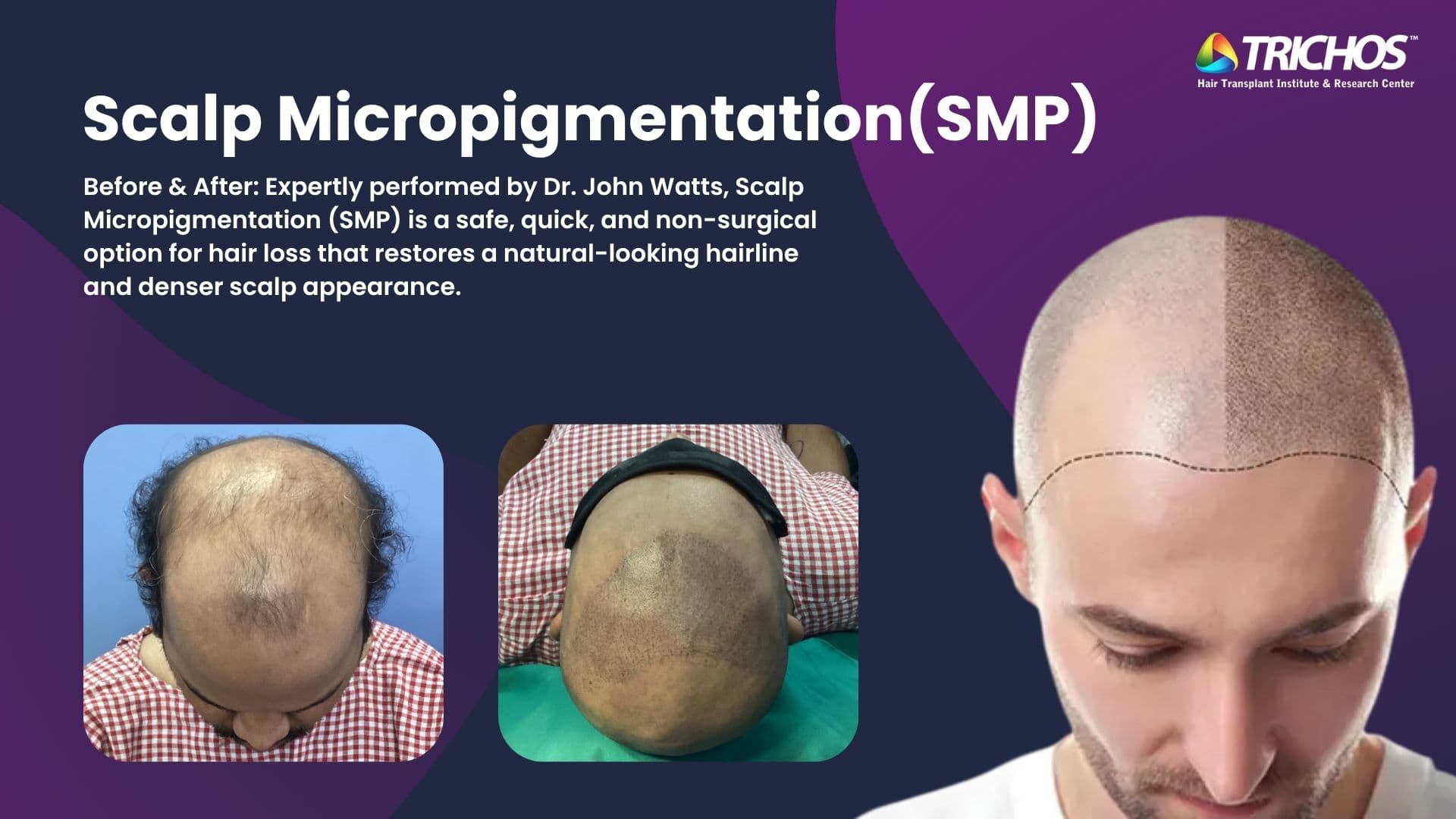 See stunning before and after results of scalp micropigmentation (SMP) by Dr. John Watts at Trichos Hair Transplant Institute, Kukatpally, Hyderabad.