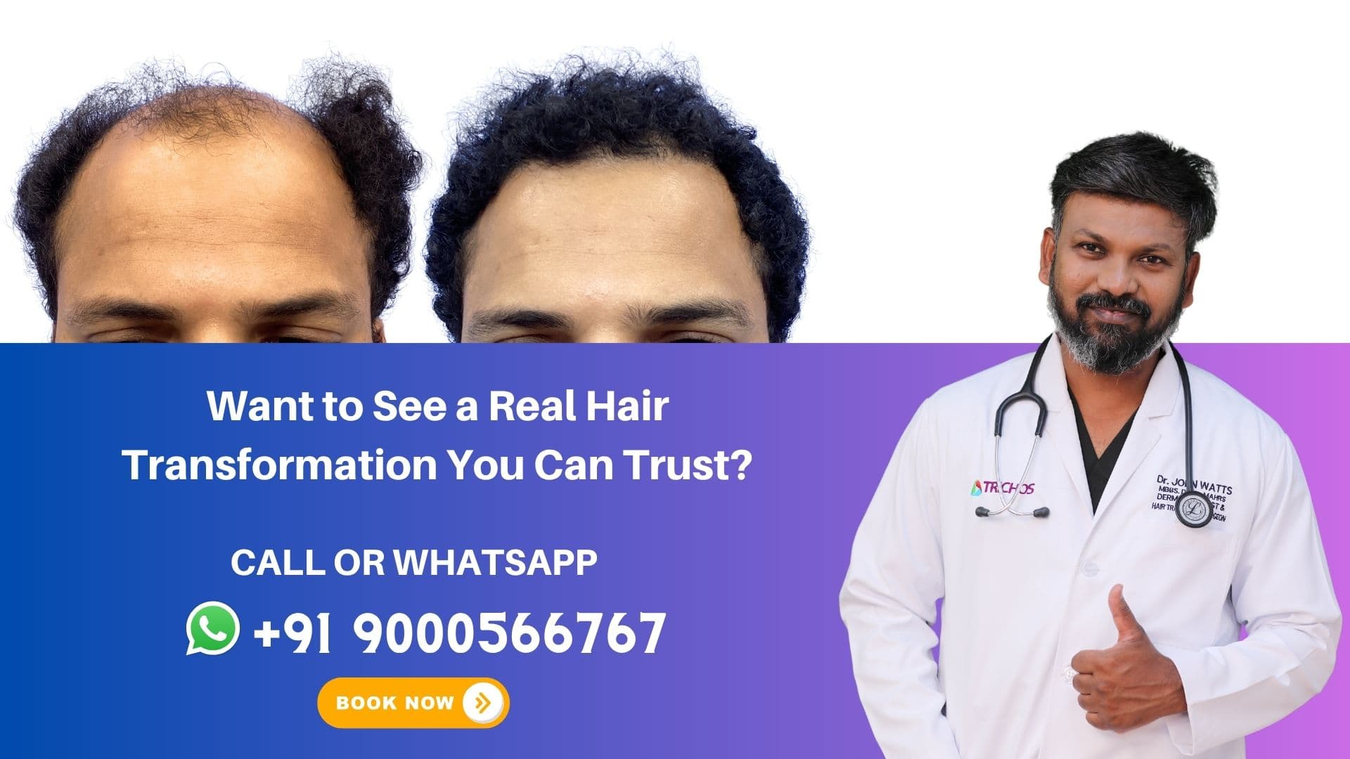 Patient achieving natural hair regrowth and fuller hairline following modern FUE hair restoration treatment at Trichos Hyderabad