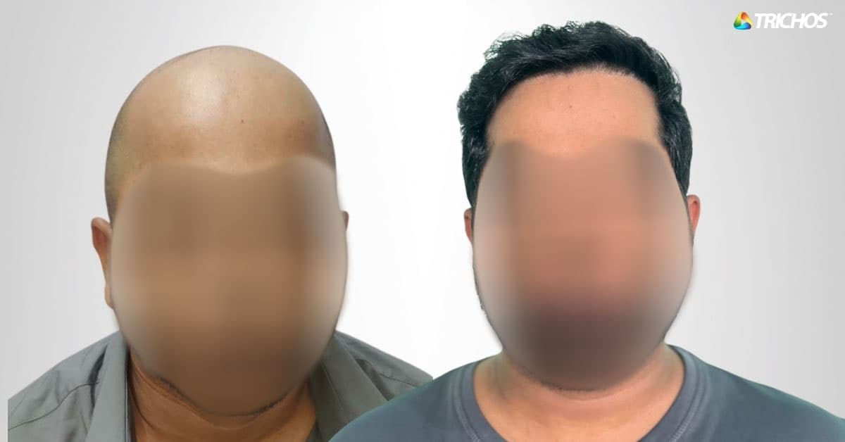 Natural hair transplant results from advanced FUE procedure at Trichos Hair Transplant Centre Hyderabad.