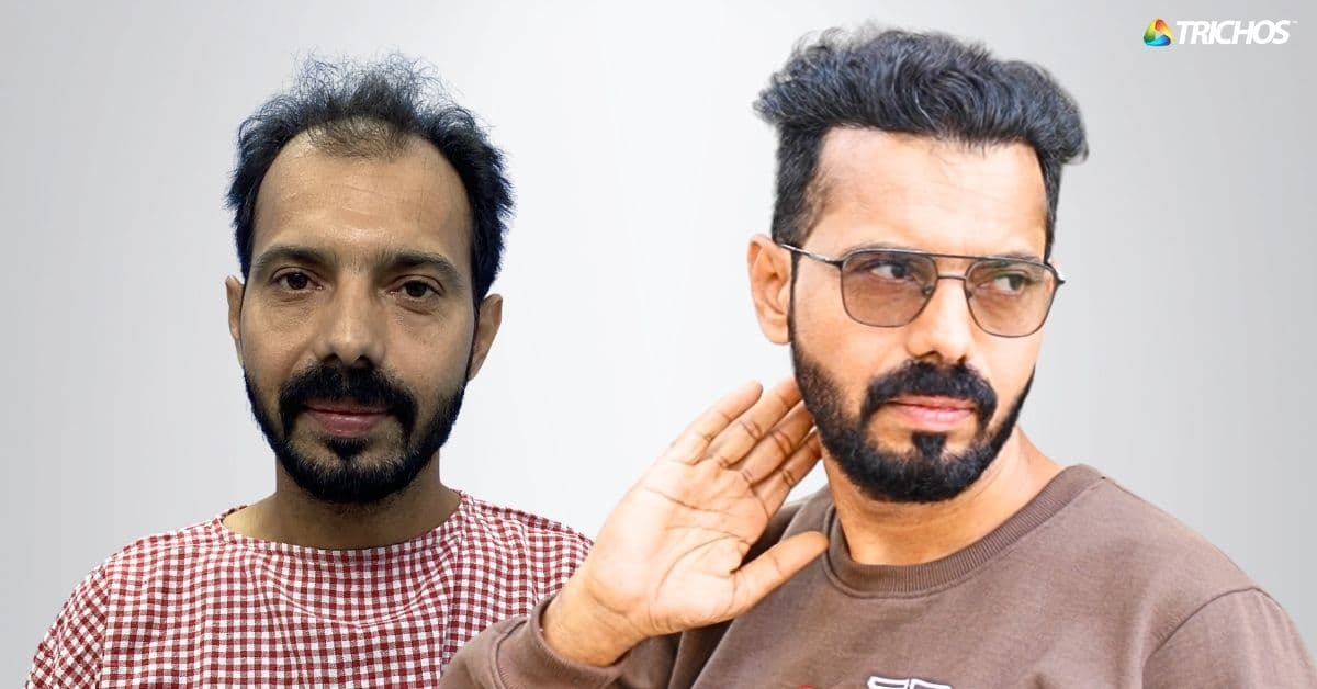 Before–after FUE transplant using 2871 grafts by Dr John Watts showing natural hairline restoration in Hyderabad.