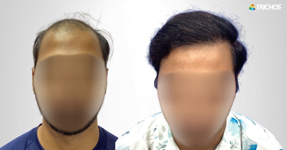 Before–after showing affordable FUE hair transplant results at Trichos Hyderabad.