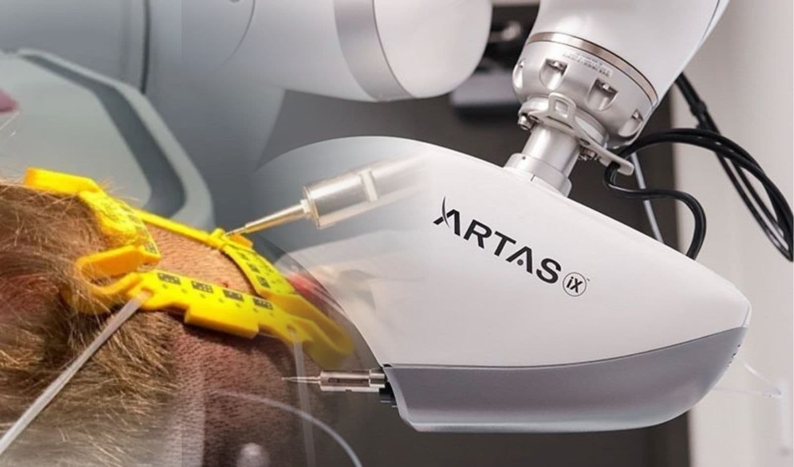 ARTAS iX – A Robotic Hair Transplant System
