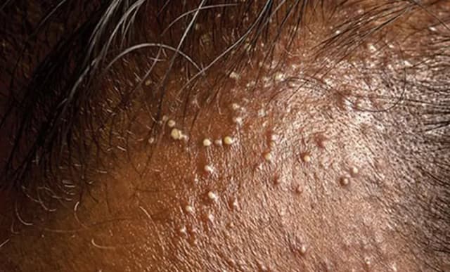 Triachos TRICHOS | Trichos Hair Loss Solution for Folliculitis Decalvans