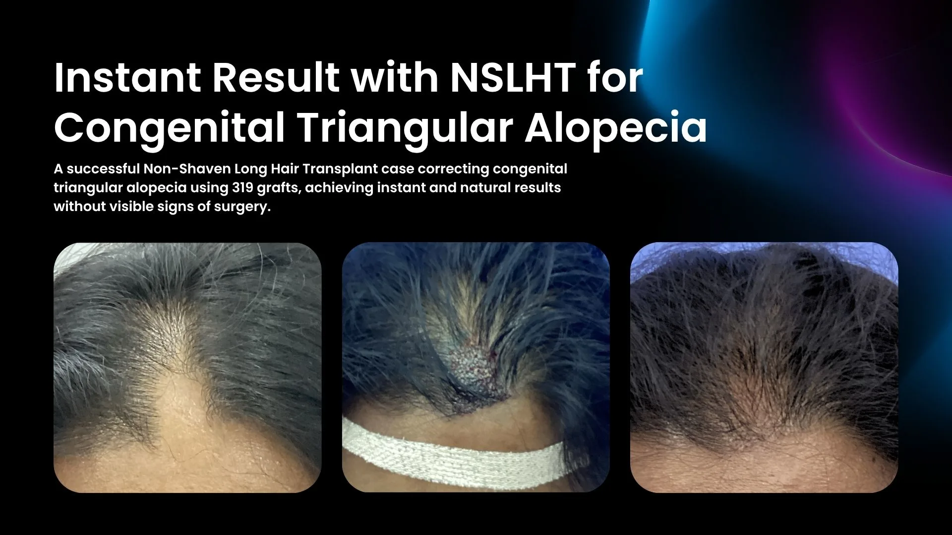 Triachos TRICHOS | Trichos | Best Long Hair Transplant | South India