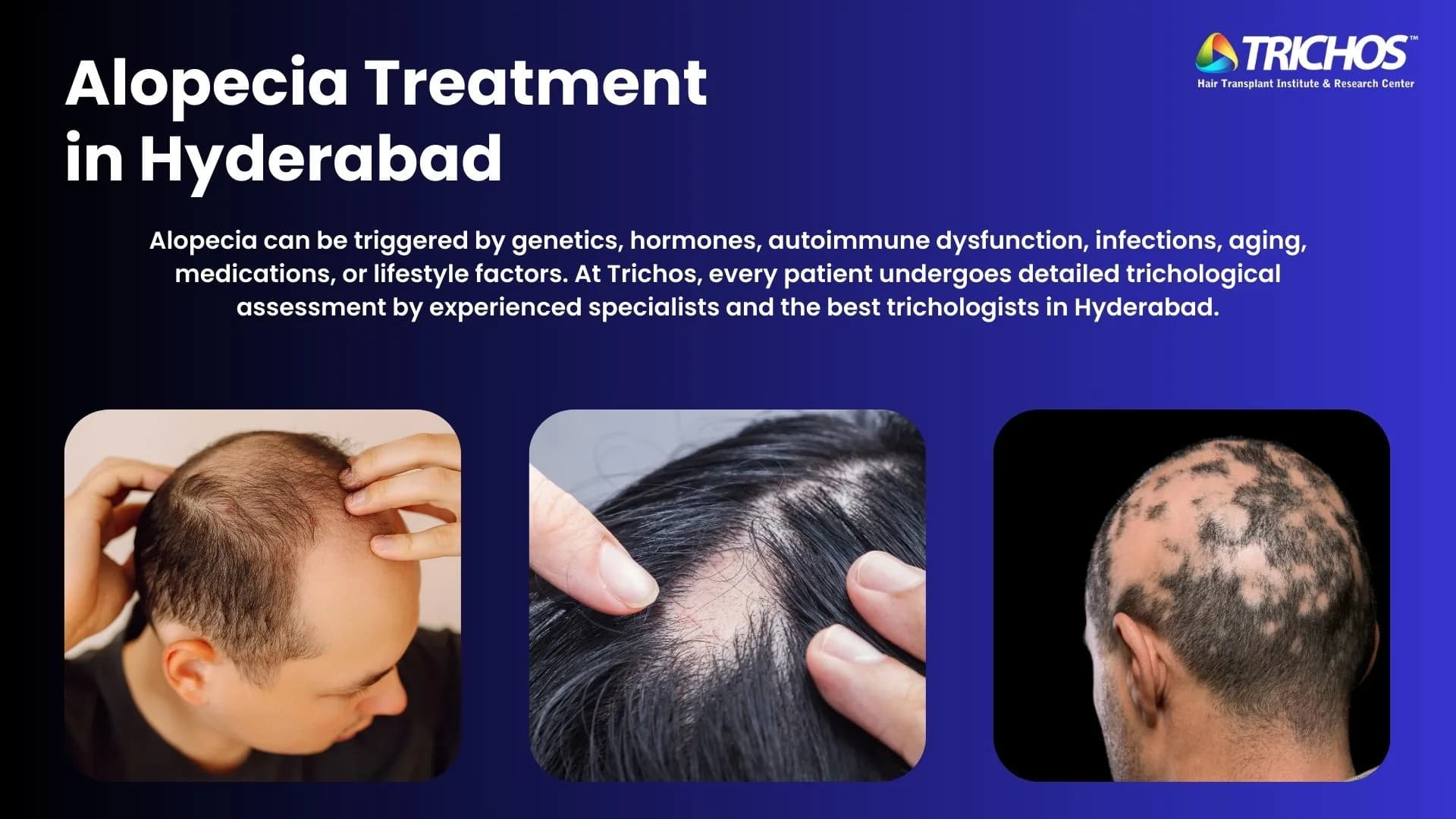 Triachos TRICHOS | Alopecia Treatment in Hyderabad | Trichos Hair Clinic | Types ...
